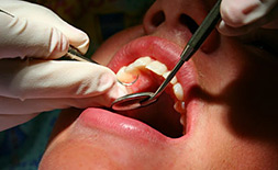 Periodontal Treatment